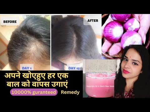 Use Onion juice like this for 30 days see extreme hair growth stop hair fall dandruff get long thick