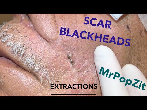 Giant blackheads imbedded in scar tissue extracted. Common occurrence with surgical procedures.