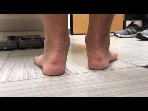 Hyprocure - Symptoms & Cure for Misaligned or Flat Feet