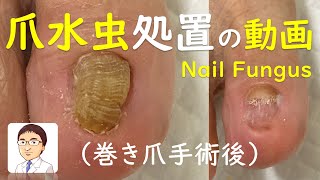 巻き爪手術後の爪白癬（爪水虫）　痛みの原因の爪肥厚を削る　Treatment of tinea unguium (nail fungus) after ingrown nail surgery