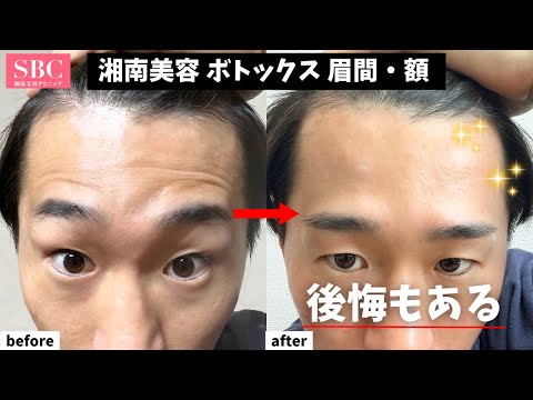 【湘南美容】ボトックスを眉間・額に入れて後悔しています。。。【美容医療失敗】