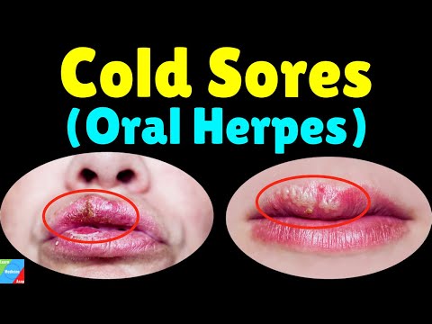 Cold Sores (Oral Herpes/HSV-1) | Fever Blisters – Symptoms, Causes, Treatment & Prevention