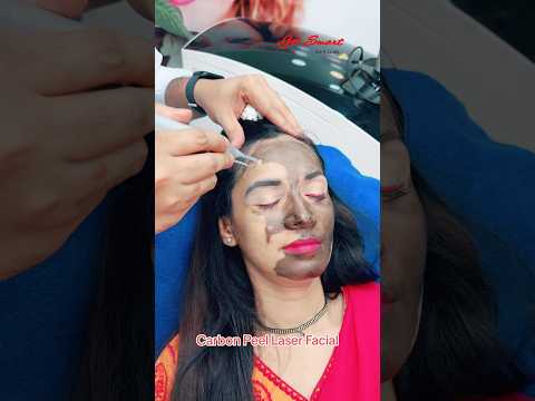 Carbon Peel Laser Facial #getsmarthairclub #beauty #viralvideo