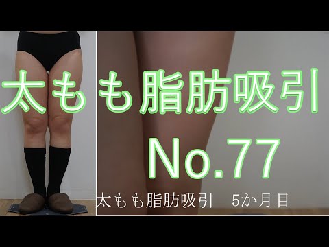 太もも脂肪吸引　77