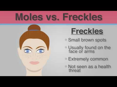 Did You Know - The Difference Between Moles & Freckles