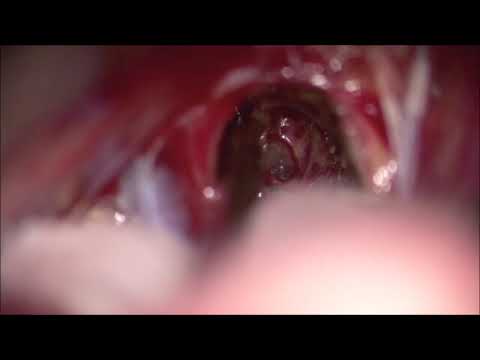 Lt suboccipital supracerebellar transtentorial approach for resect. of tectal cavernous malformation