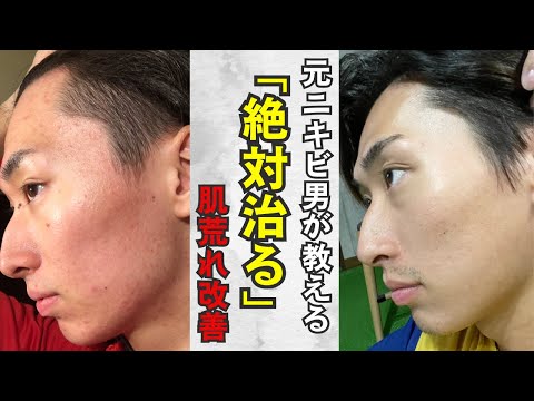 【ニキビ】人に会いたくない程の肌荒れ｜元ニキビ男が教える肌荒れ改善方法！