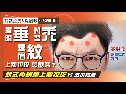 前額拉皮&提眉眼（須知-6）眉眼下垂又有M型禿 哪一種前額拉皮適合我？ 「新式內視鏡上額拉皮」VS「傳統五爪拉皮」優缺點比較 38-20241218