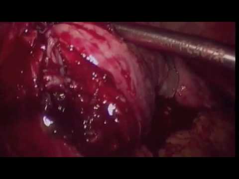 Laparoscopic myomectomy using Quill SRS Dr Rooma Sinha, Hyderabad.m4v