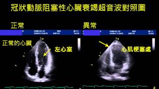 冠狀動脈硬化-超音波檢查對照圖-3