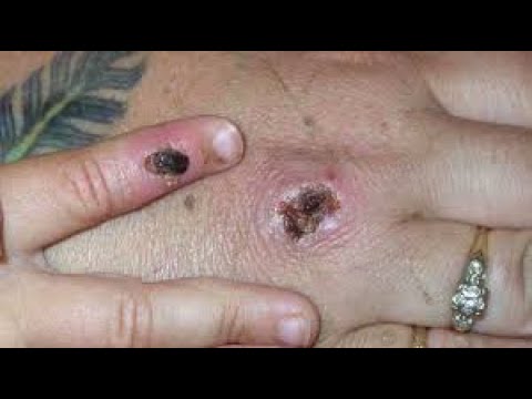 dr pimple popper blackheads