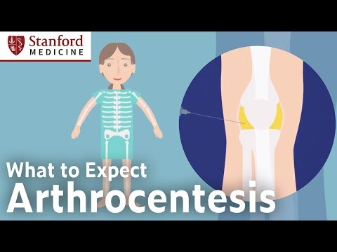 Arthrocentesis – What to Expect