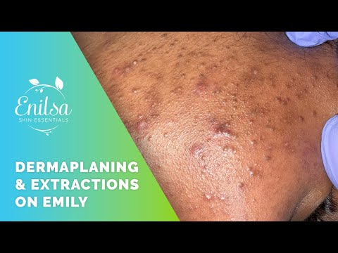 Light Dermaplaning + Blackhead Extractions on Emily