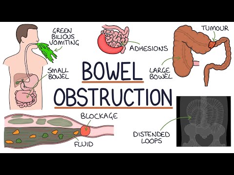 Understanding Bowel Obstruction