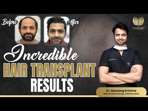 Incredible Hair Transplant Results | 9 Month Hair Transplant Results | Medlinks