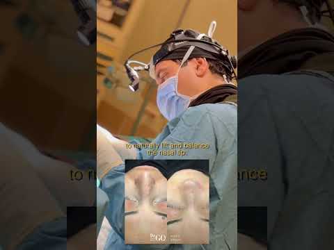 Behind the Scenes: A Day in Rhinoplasty Surgery with Assoc. Prof. Dr. Güncel Öztürk