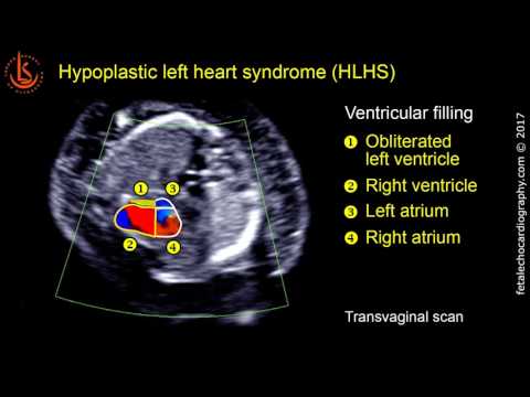 Fetal echocardiography at 11-13 weeks: Hypoplastic Left Heart Syndrome (HLHS)