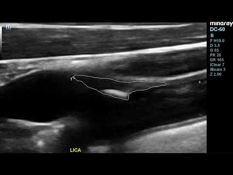 Magnified images and videos from various carotid plaques (Duplex Ultrasound, B-Mode)