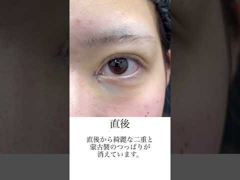 目頭切開＋埋没二重