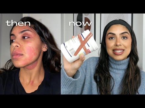 how i naturally healed my chronic eczema in 8 months | diet, routine, holistic healing, skincare etc