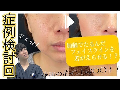 【症例検討回その④】たるんだフェイスラインを若返らせる！若返り＆小顔治療【美の主治医京様】