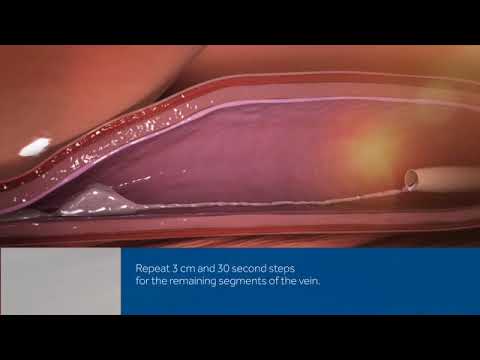 VenaSeal™ Closure System - Heart & Vascular Care Video