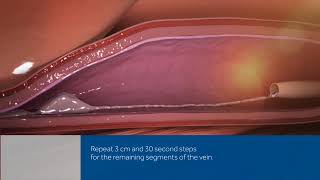 VenaSeal™ Closure System - Heart & Vascular Care Video