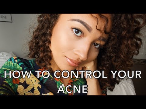 HOW TO CONTROL YOUR ACNE