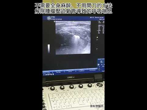 甲狀腺腫瘤射頻消融術：不開刀的另一項選擇 RF ablation of thyroid tumor