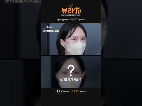 나이 들어보이는 ⚠꺼진 눈꺼풀⚠ 필러로 간편하게 해결! #shorts