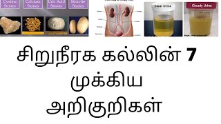 7 symptoms of kidney stone in tamil | Joyal Health tamil