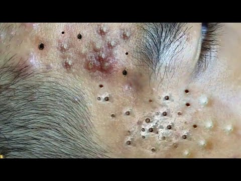 New Blackheads and Pimples Popping this week #023