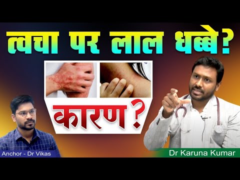 Red Spots over Skin | Causes for Purpura and Excessive bleeding | Dr Karuna Kumar | Hematologist