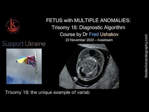 Fetus with Anomalies: Diagnostic Algorithm (T18): Fundraising Event for Ukraine Support. 22/11/22