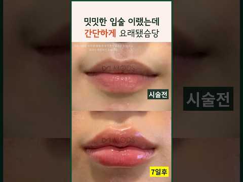 밋밋한 입술 탈출 간단하게 인상 개선 | 전후비교 시술영상 입술필러 #modsclinic #입술필러  #입술 #filler