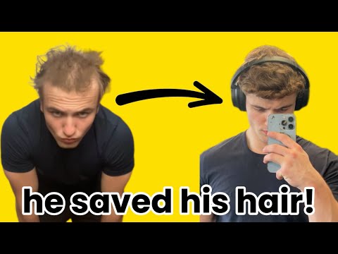 Luke’s CRAZY hair loss transformation!