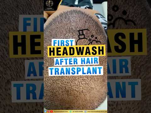 Headwash After Hair Transplant #hair #hairtransplant #ytshorts #shorts #drpranilmore