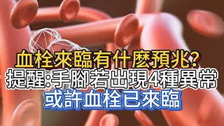 血栓來臨有什麽預兆？提醒：手腳若出現4種異常，或許血栓已來臨