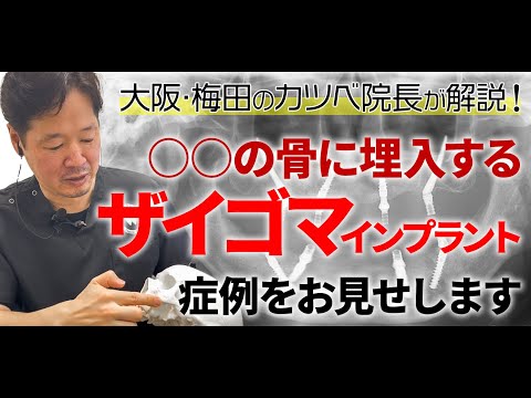 【オールオン4の話⑦】ザイゴマインプラントの症例をご紹介！顎の骨が少なくても頬骨に埋め込んでAll-on-4ができる可能性があります🔩