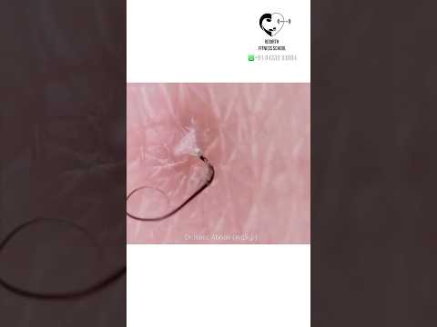 Ingrown Hair - Dr. Isacc Abbas