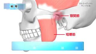 顎関節症／ミルメディカル　家庭の医学 動画版