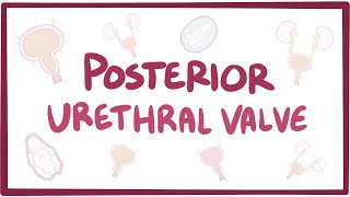 Posterior urethral valve (PUV) - causes, symptoms, diagnosis, treatment, pathology