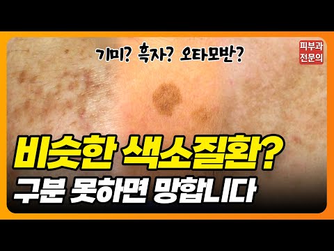 이게 다 같은 색소질환이 아닙니다!! #기미 #흑자 #오타모반 #피부과전문의