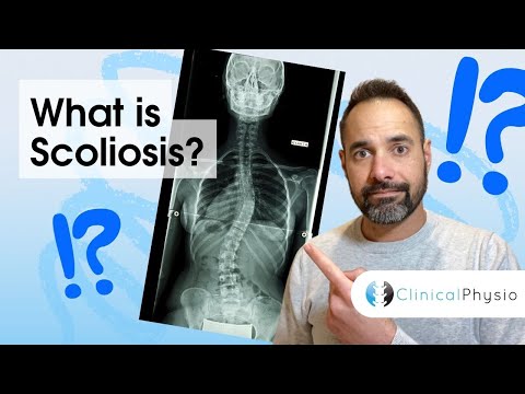 What is Scoliosis? | Expert Physio Explains