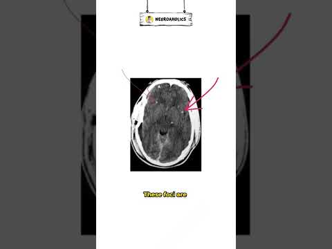 Diffuse Axonal Injury #shorts #short