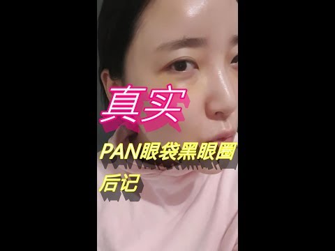 香香小姐的黑眼圈矯正日記3. PAN眼袋黑眼圈矯正術后第5天的真實自拍