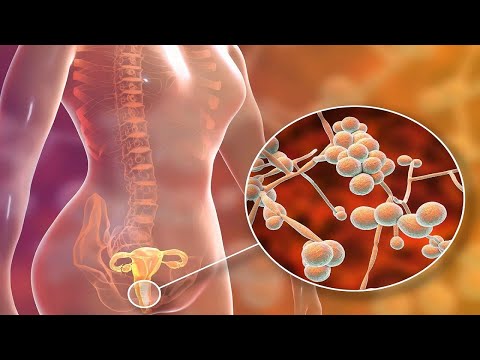 Effective Home Remedies for Candida: Natural Solutions for Fast Relief