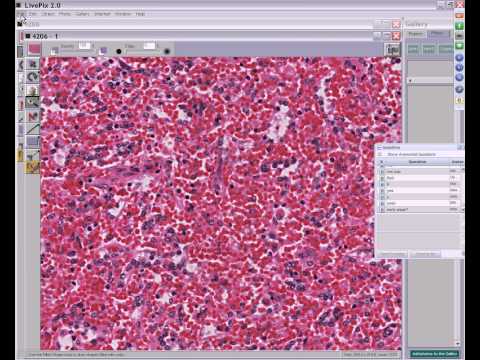 Medical School Pathology, 2013 Season, Session #55: Hem-Lab-II and Lung-I