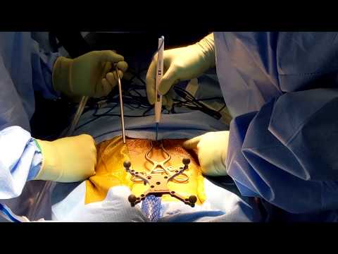 Closure of L3 pedicle subtraction osteotomy via an open-bottom hinged table in 3D video