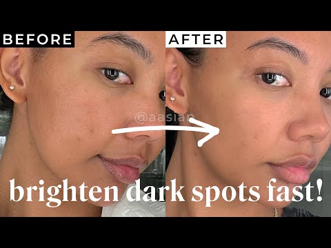 HOW TO BRIGHTEN DARK SPOTS IN 12 DAYS | pih, dark spots, acne scars